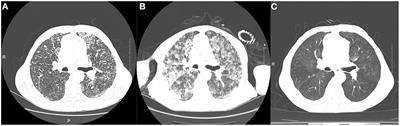 A case of severe leptospirosis with Jarisch–Herxheimer reaction presenting as respiratory failure